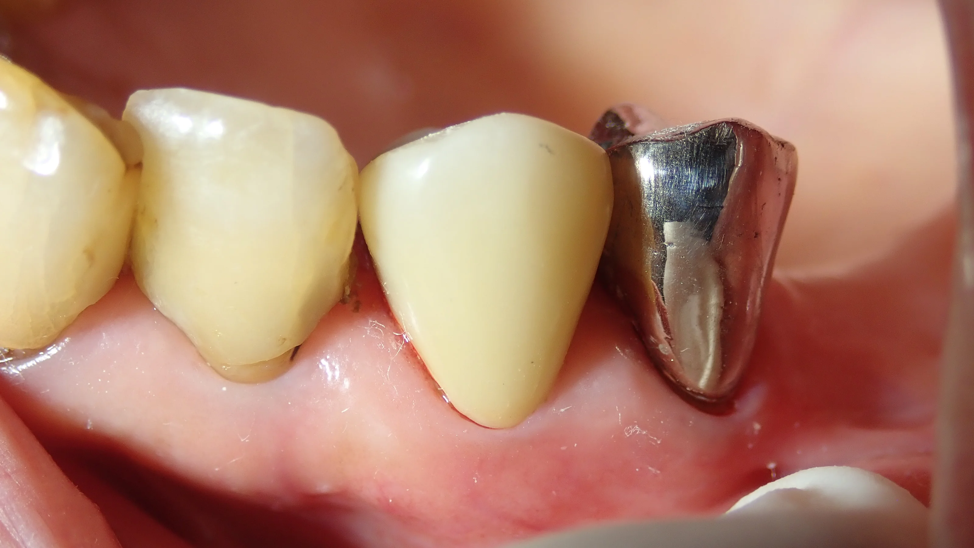 硬質レジンジャケット冠｜坂寄歯科医院（取手市藤代） - 画像6