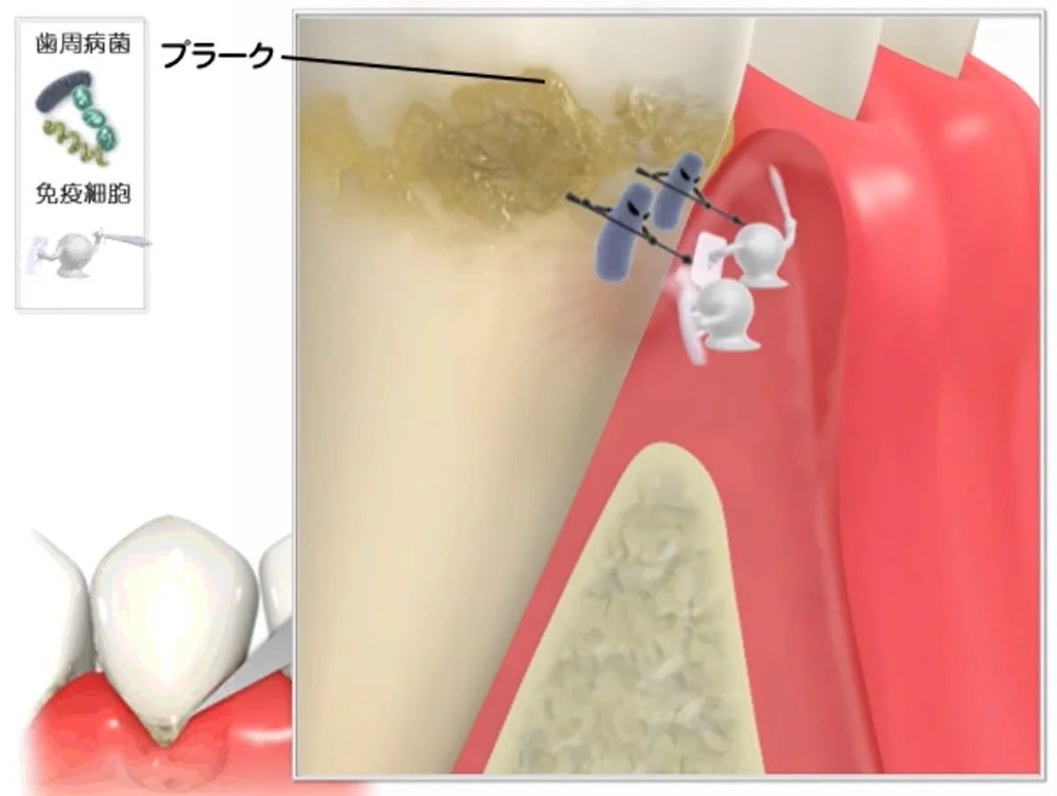 体の免疫がプラークに抵抗している状態の断面図