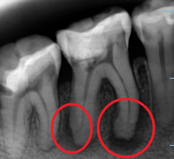 神経の治療②｜坂寄歯科医院（取手市藤代） - 画像2
