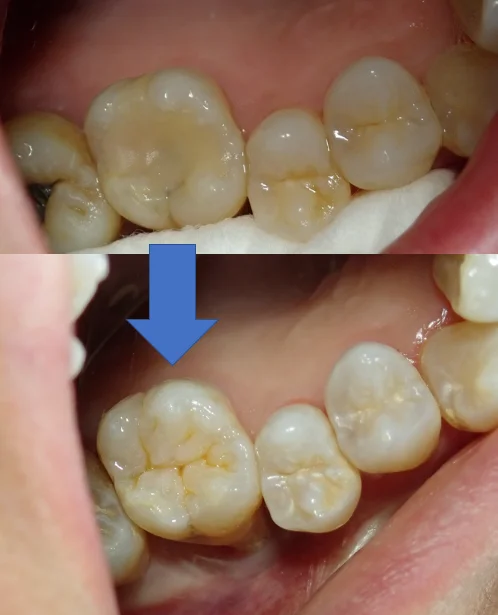 右上6ダイレクトボンディング｜坂寄歯科医院（取手市藤代） - 画像7