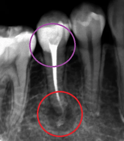 神経の治療③｜坂寄歯科医院（取手市藤代） - 画像2