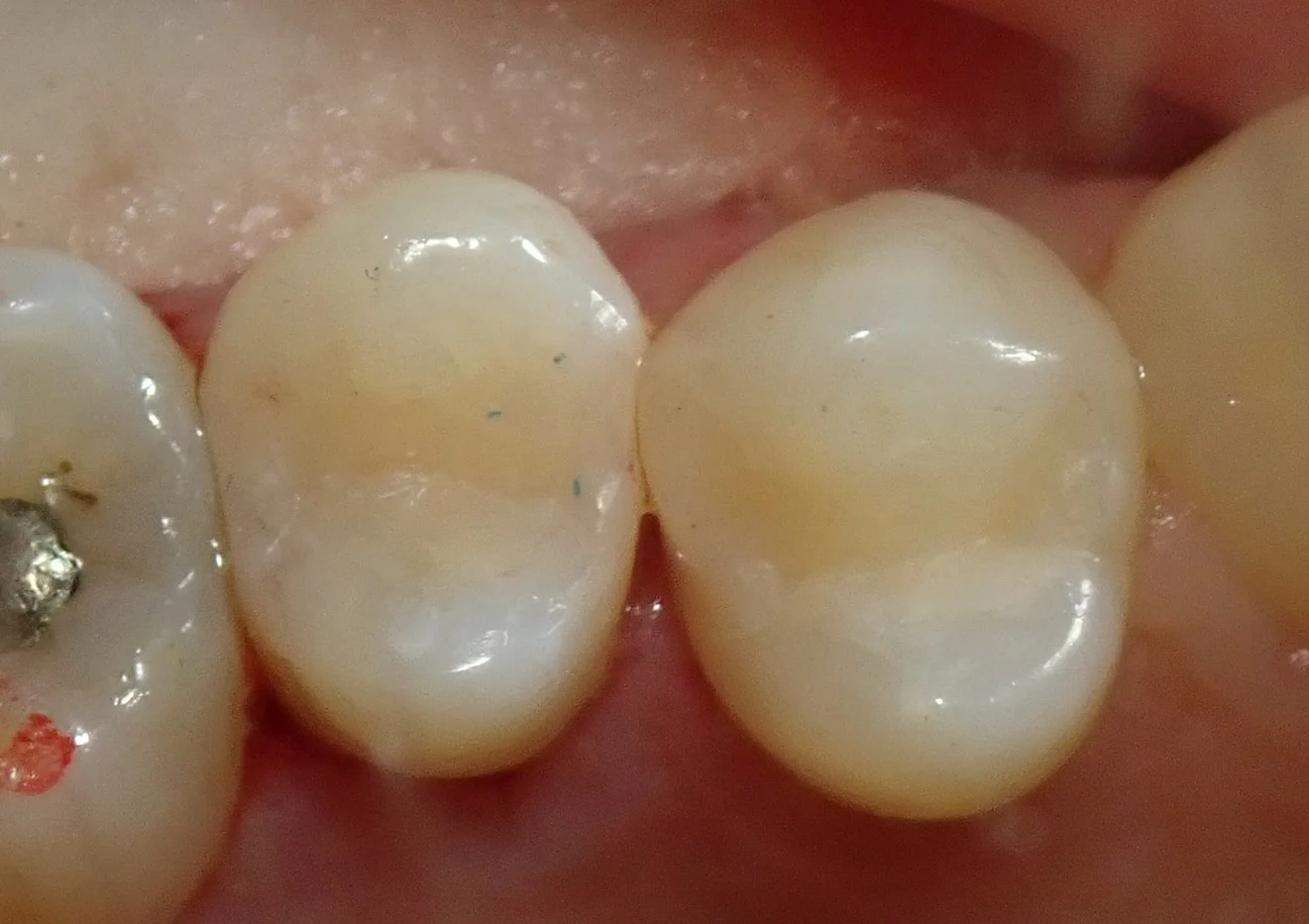 保険の白い詰め物｜坂寄歯科医院（取手市藤代） - 画像5