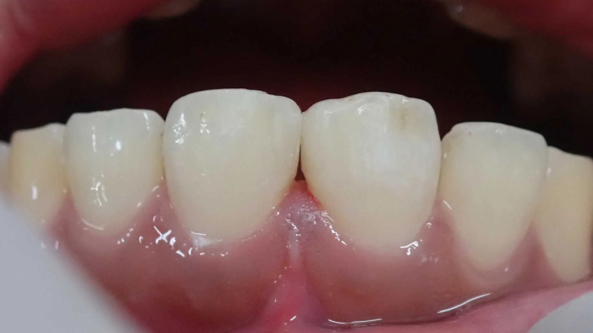 正中離開（すきっ歯）の治療｜坂寄歯科医院（取手市藤代） - 画像3