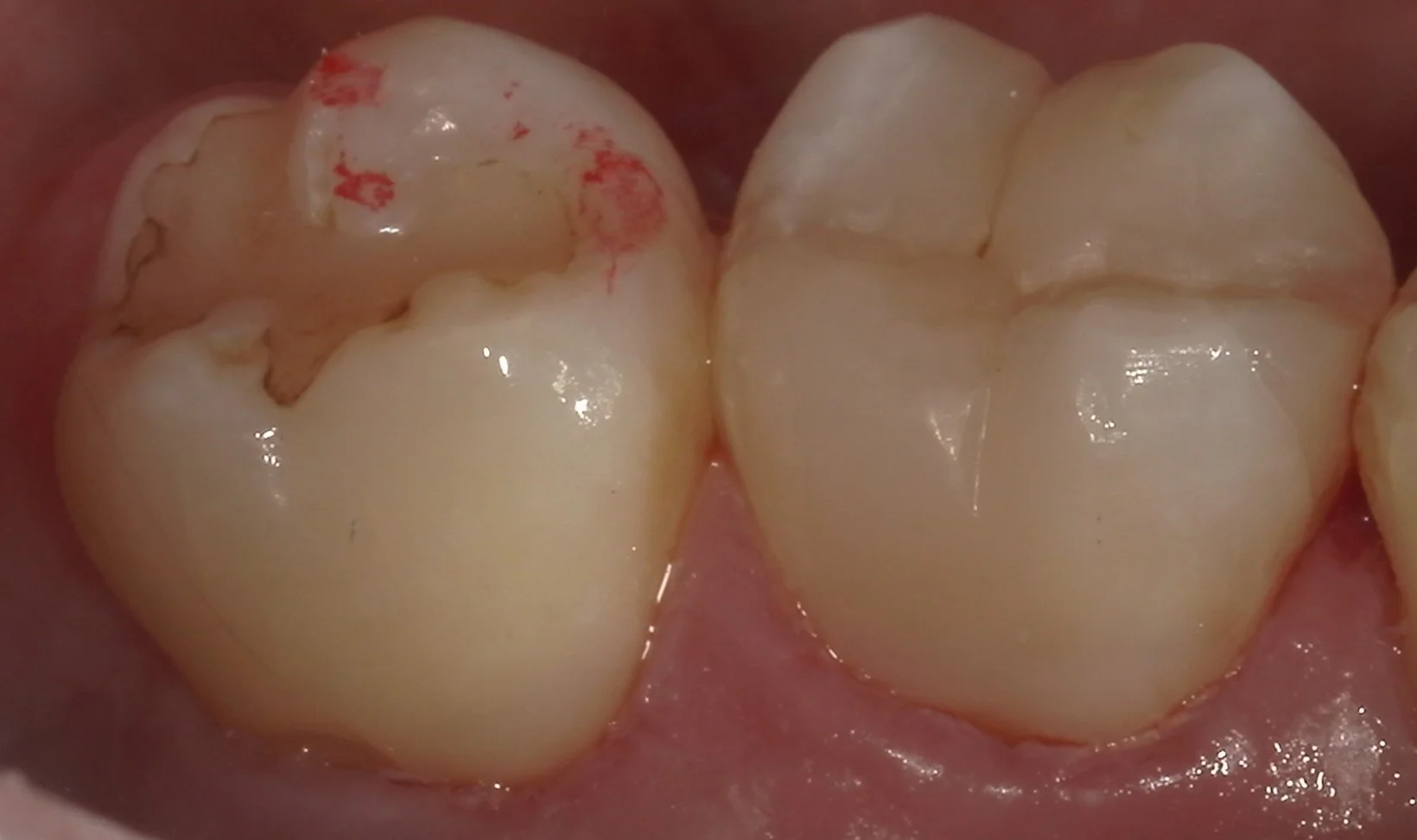 歯の側面も同時に治療したケース。｜坂寄歯科医院（取手市藤代） - 画像6