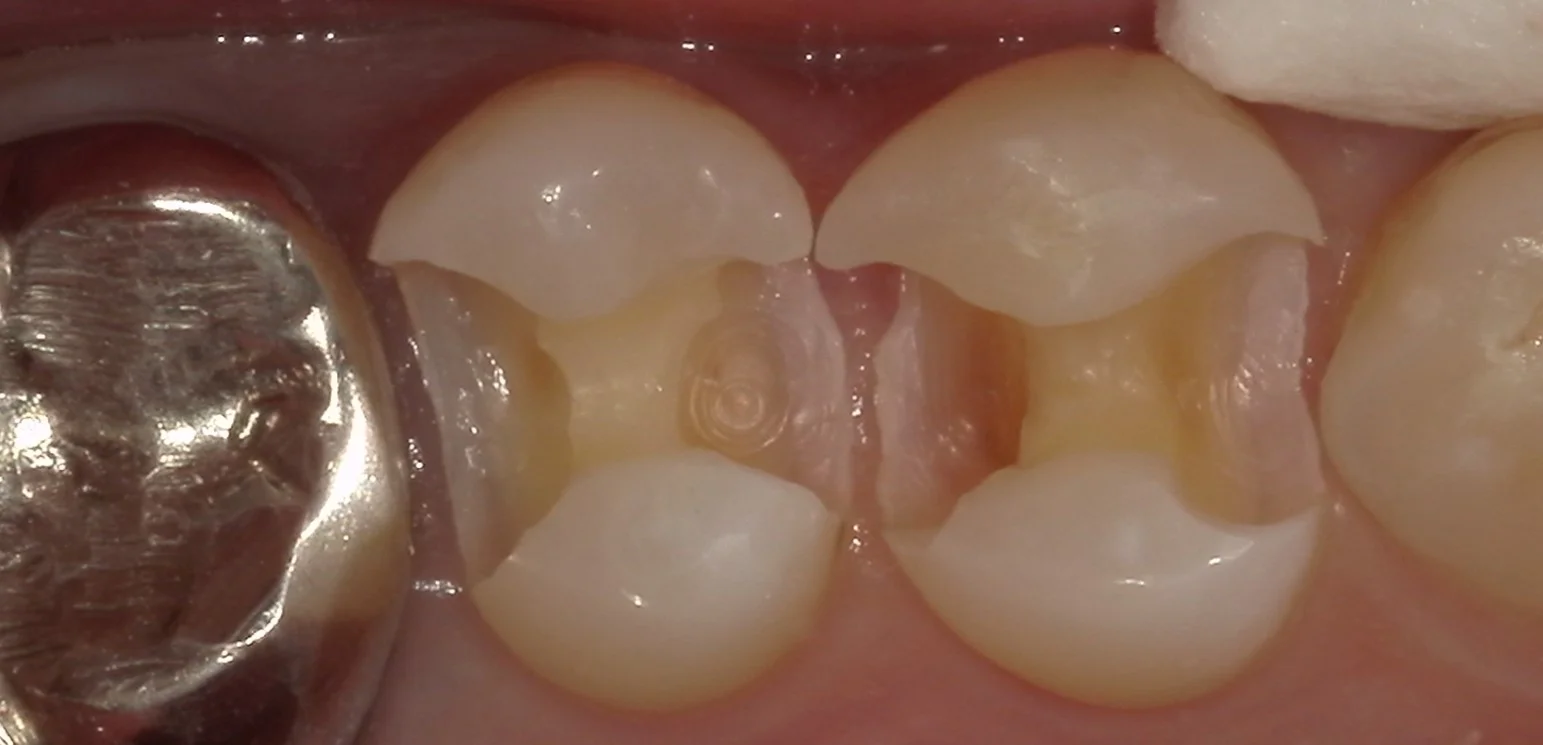 保険内の白い詰め物(コンポジットレジン修復)｜坂寄歯科医院（取手市藤代） - 画像3