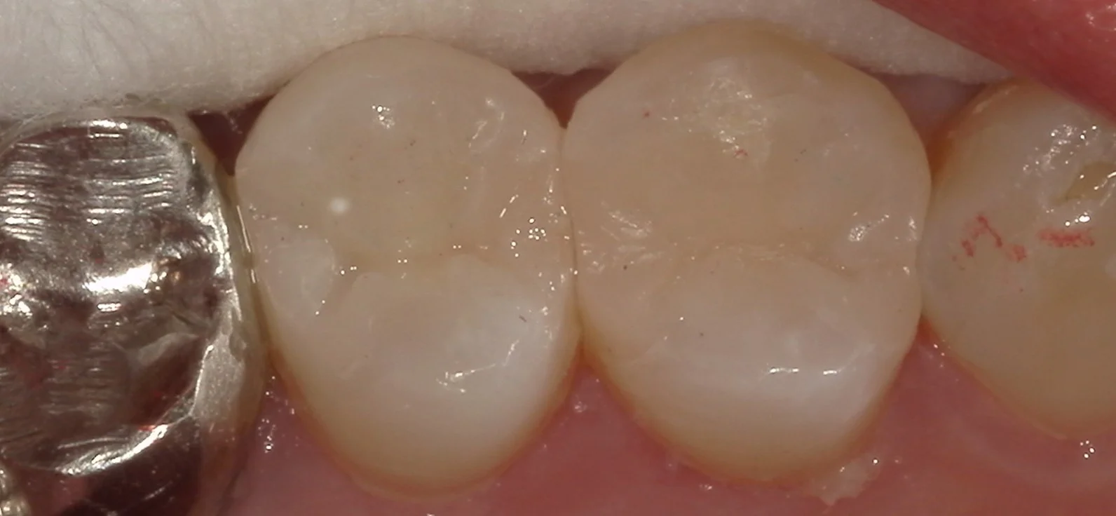保険内の白い詰め物(コンポジットレジン修復)｜坂寄歯科医院（取手市藤代） - 画像4