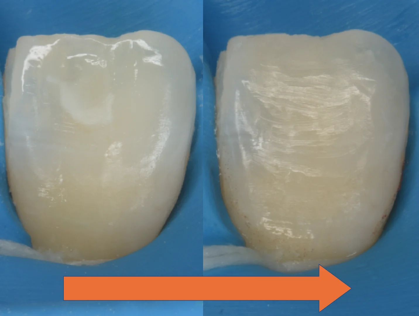 ICON治療にて改善しきらなかったケース。｜坂寄歯科医院（取手市藤代） - 画像3