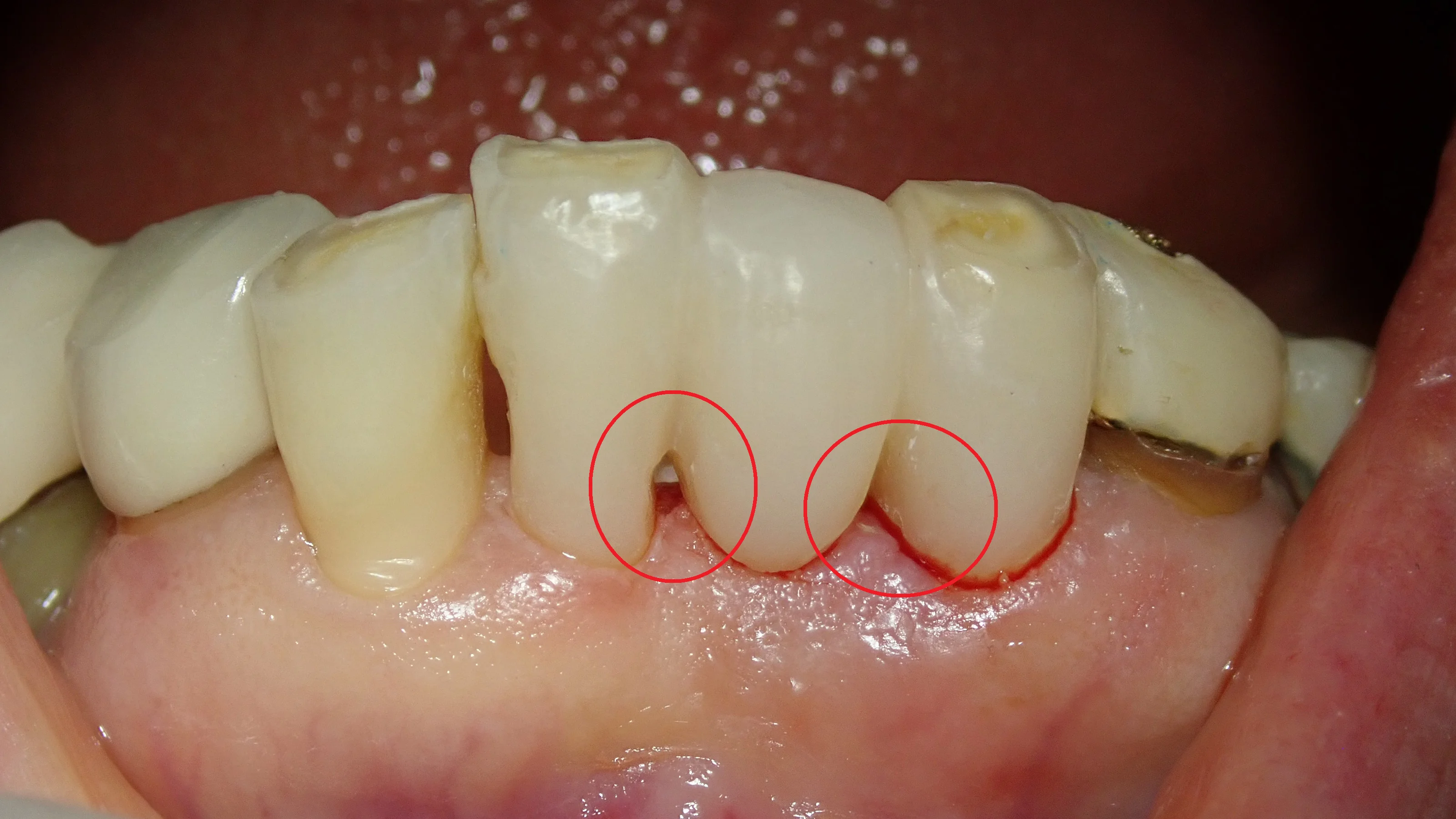 接着性ブリッジ｜坂寄歯科医院（取手市藤代） - 画像3