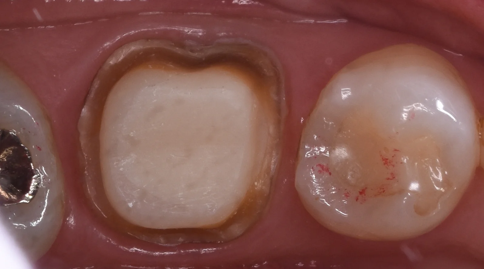 セラミックの被せ物｜坂寄歯科医院（取手市藤代） - 画像2