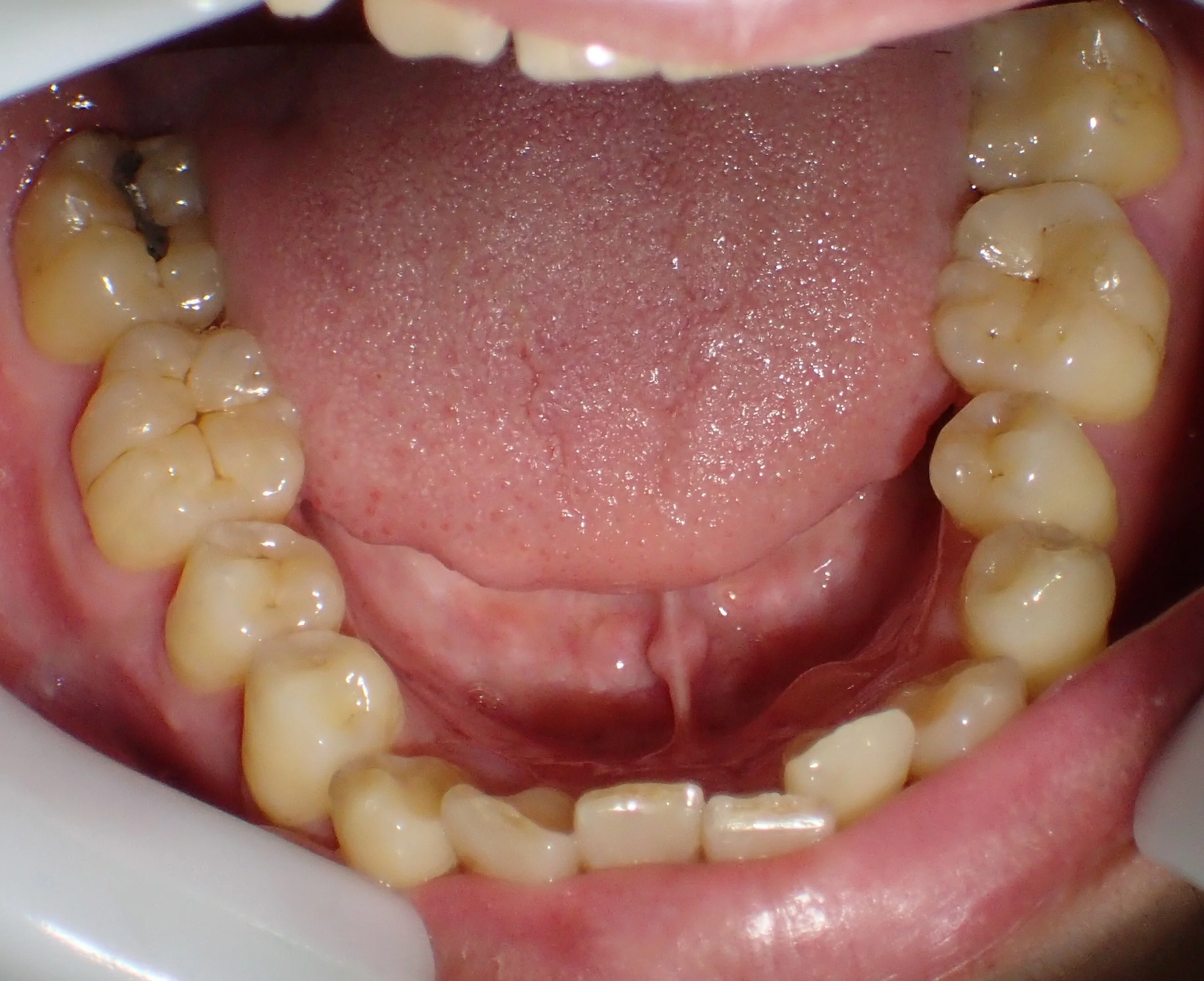 ダイレクトボンディングによる治療｜坂寄歯科医院（取手市藤代） - 画像2