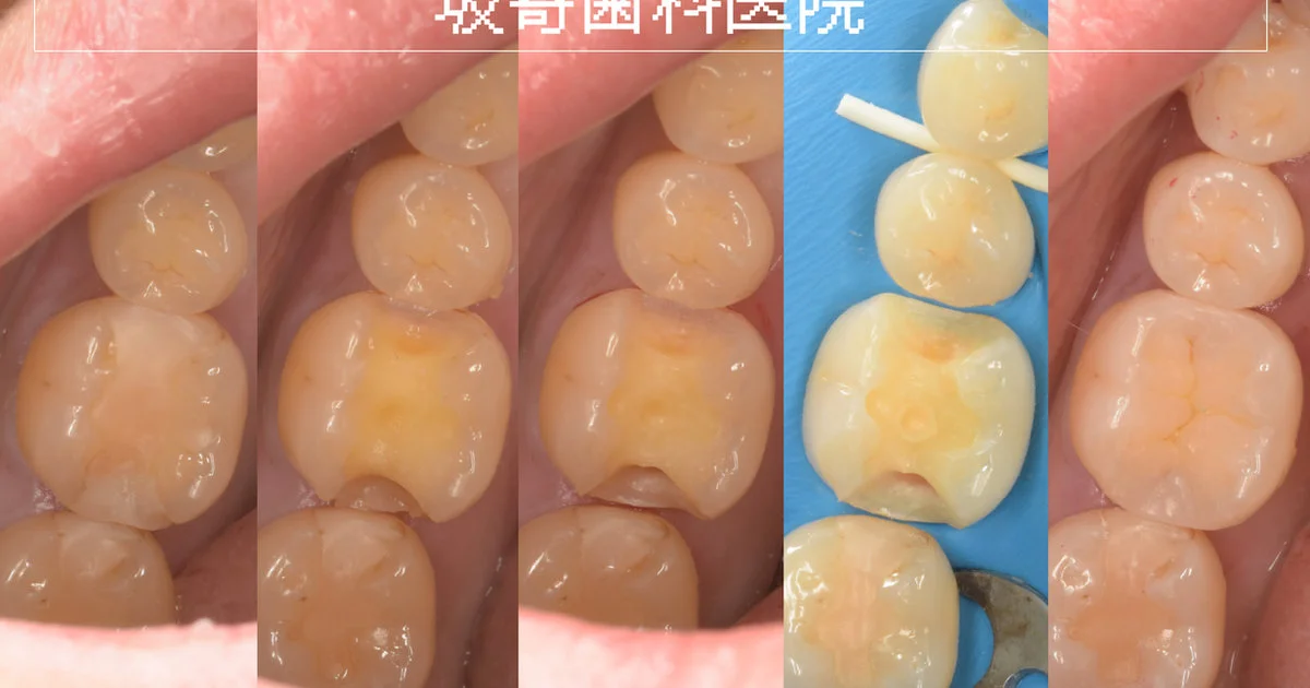 セラミックインレー破損の再治療｜右下6をダイレクトボンディングで修復した症例（4