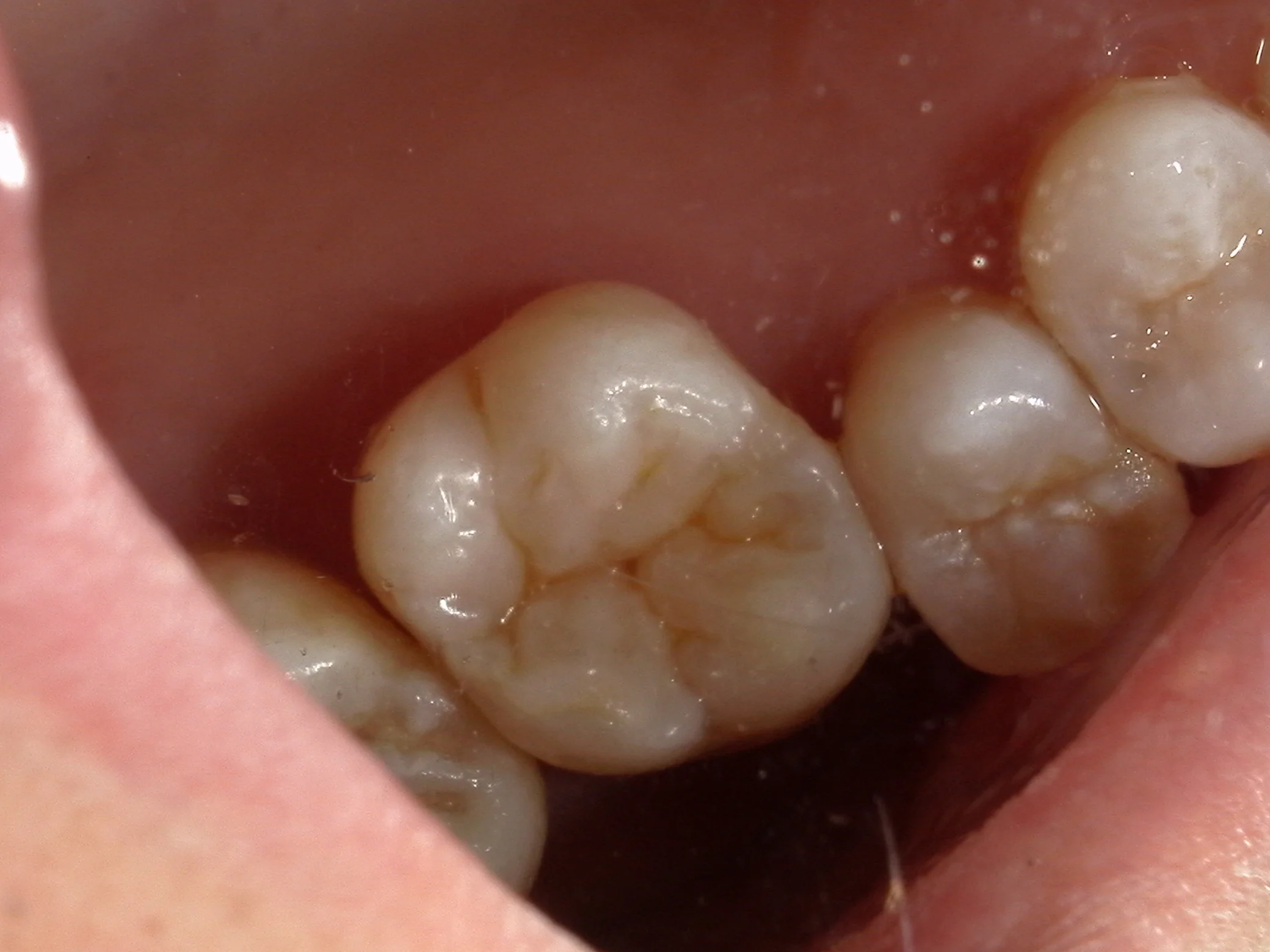 右上6ダイレクトボンディング｜坂寄歯科医院（取手市藤代） - 画像5