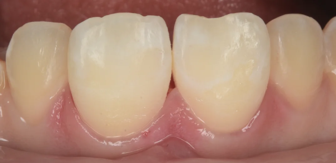 遠方よりICON治療を求めて・・・|坂寄歯科医院(取手市藤代) - 画像4