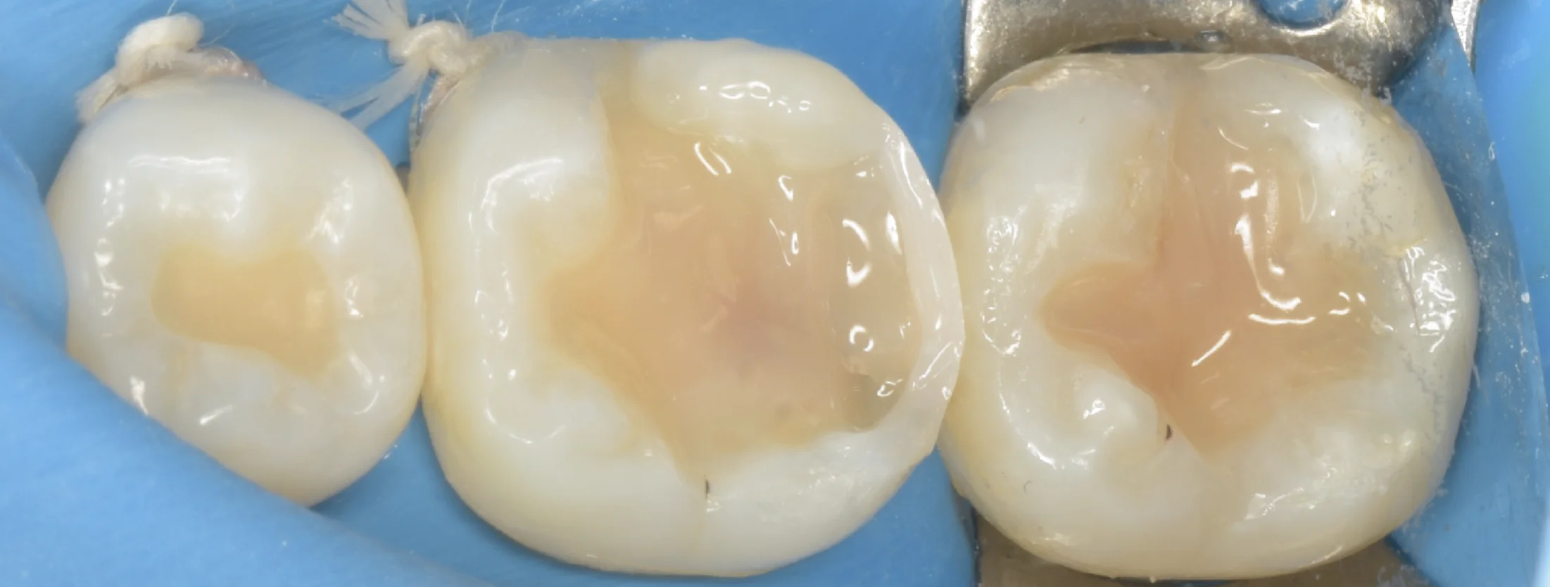 歯科医師の方のCAD/CAMインレーを治療。｜坂寄歯科医院（取手市藤代） - 画像6