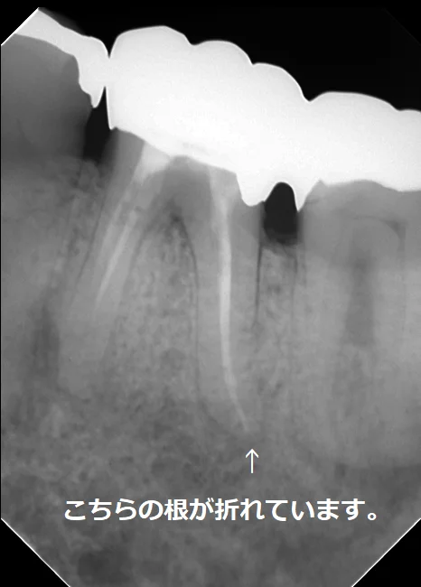 その抜歯ちょっと待って!|坂寄歯科医院(取手市藤代) - 画像2