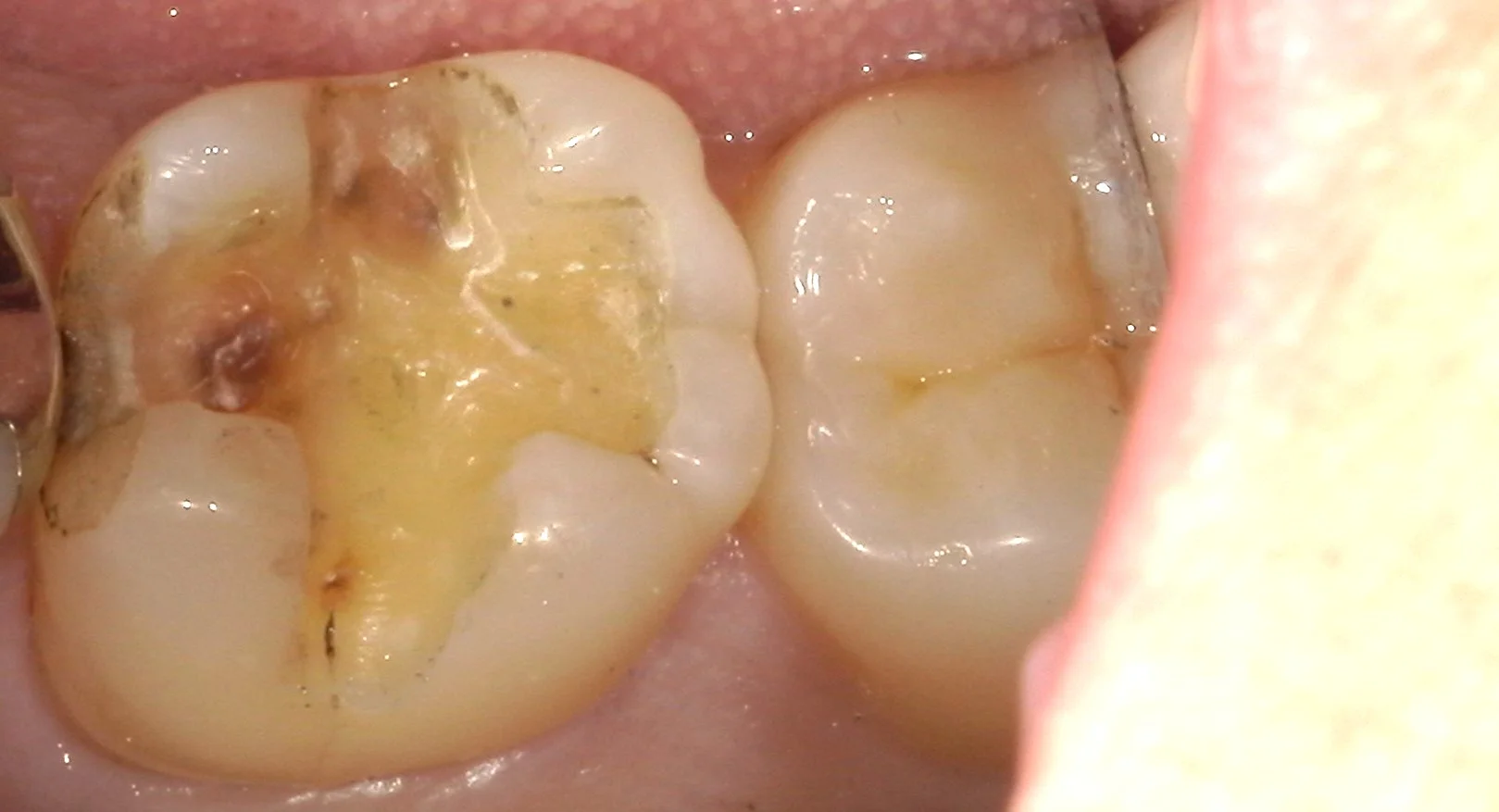 奥歯の自費の白い詰め物。術後数週間後もあります。｜坂寄歯科医院（取手市藤代） - 画像2
