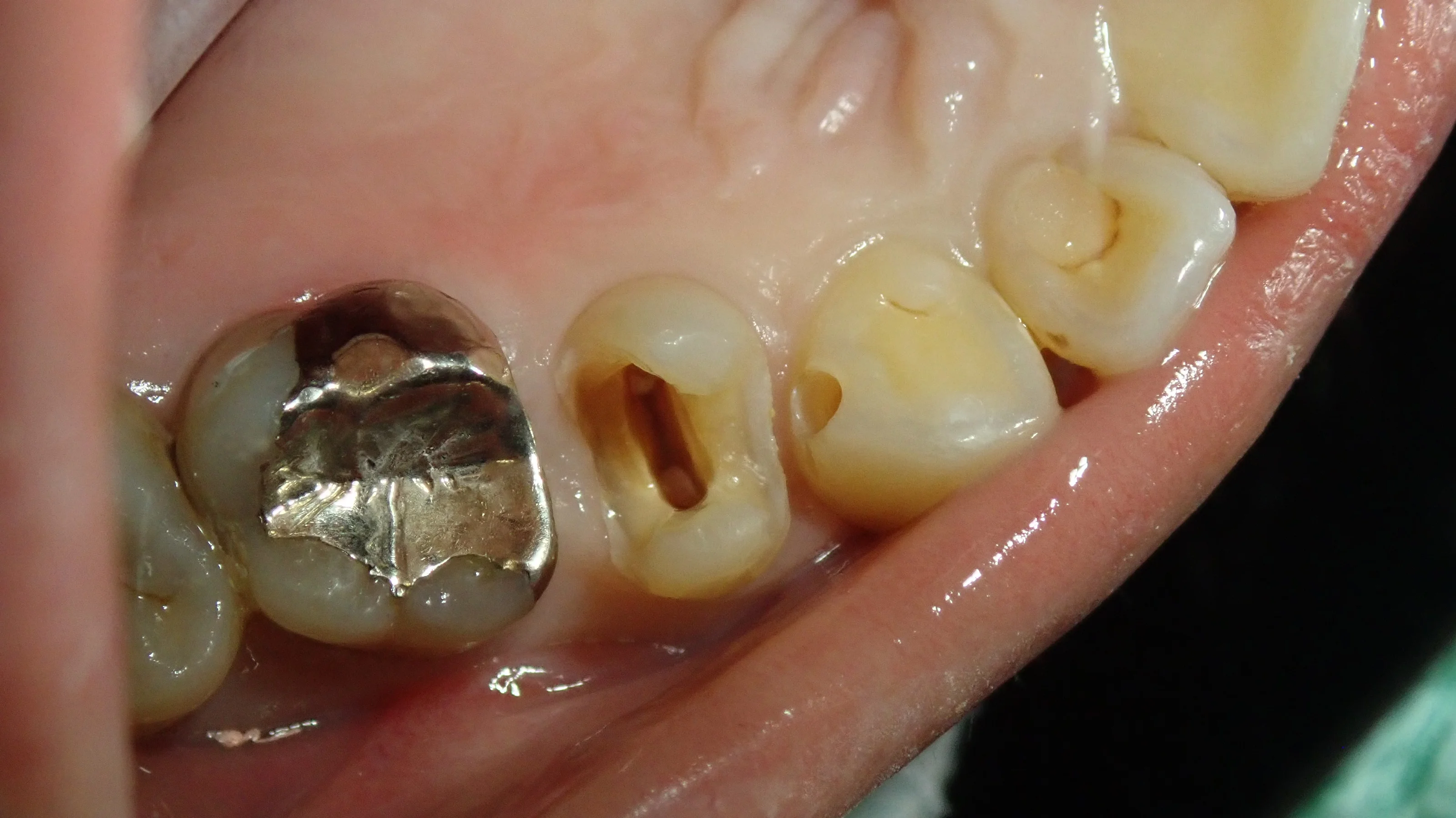 犬歯と奥歯の白い詰め物｜坂寄歯科医院（取手市藤代） - 画像3