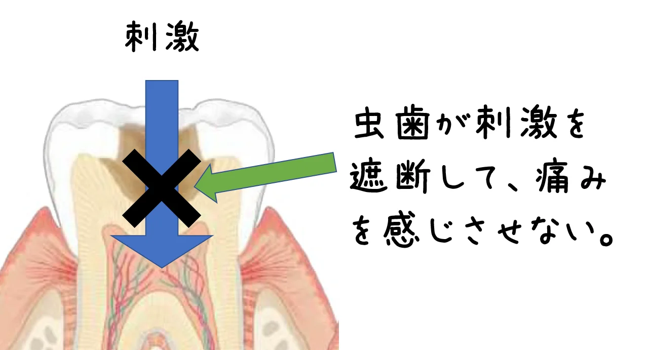 虫歯治療後の歯髄へのダメージの模式図