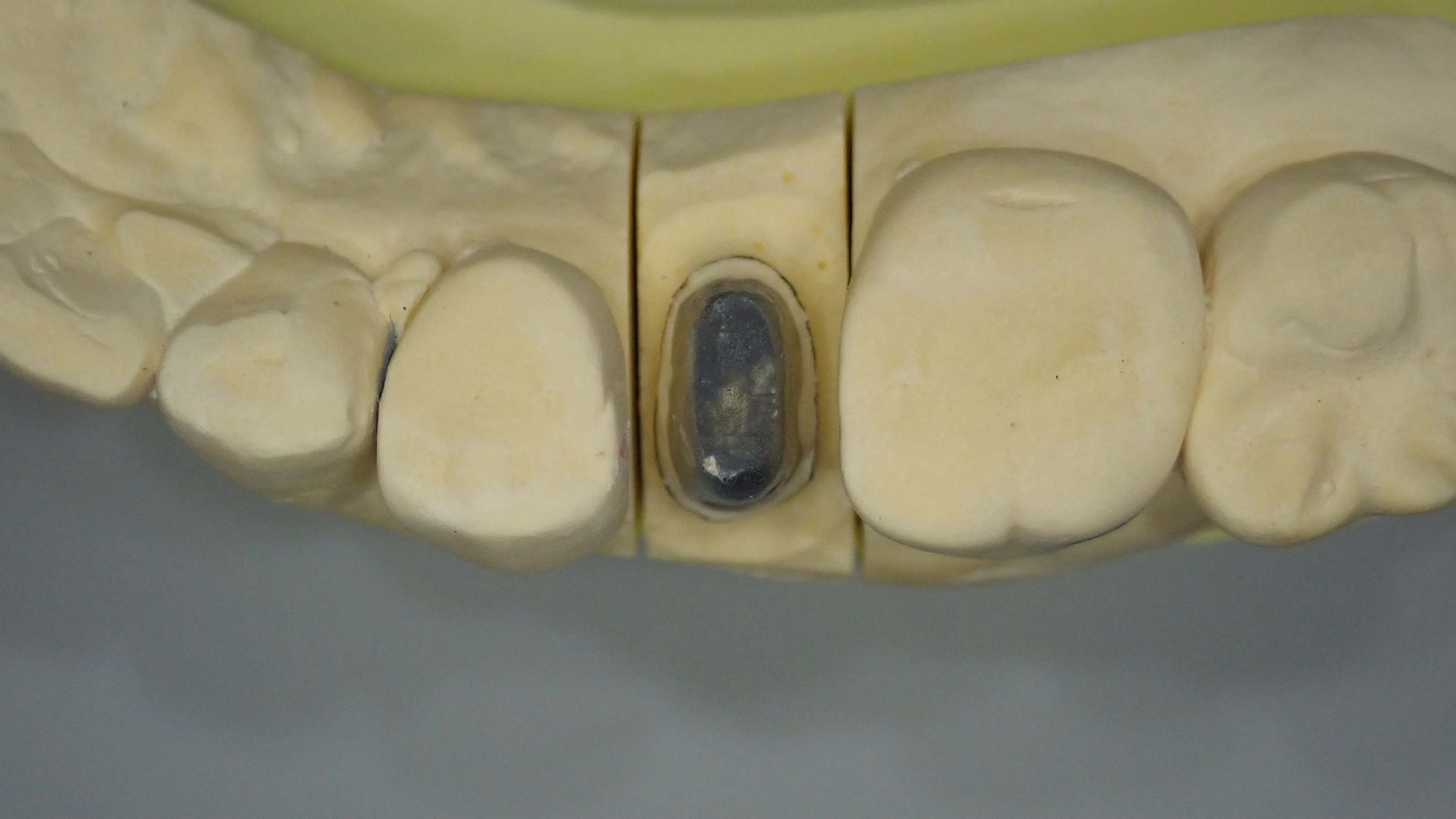メタルクラウン｜坂寄歯科医院（取手市藤代） - 画像3