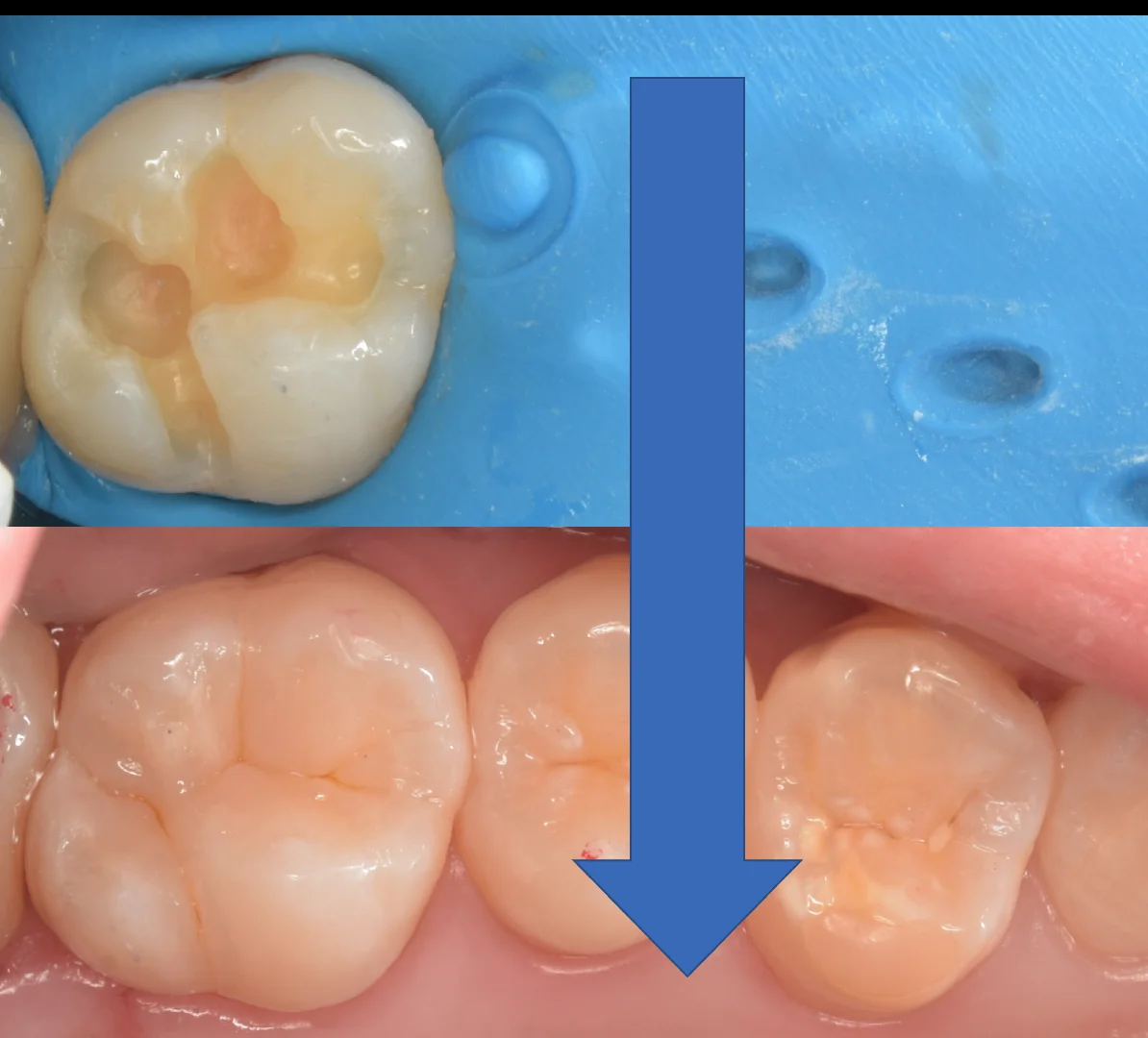 自費の白い詰め物。｜坂寄歯科医院（取手市藤代） - 画像5