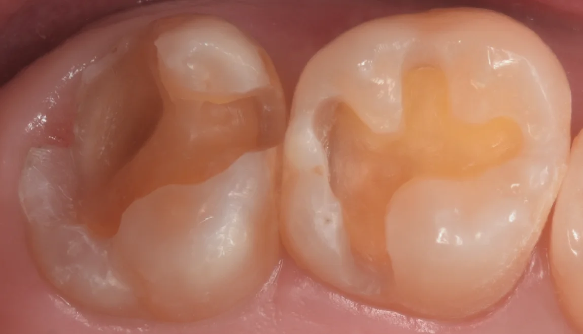 他院で入れたセラミックをダイレクトボンディングに。|坂寄歯科医院(取手市藤代) - 画像3