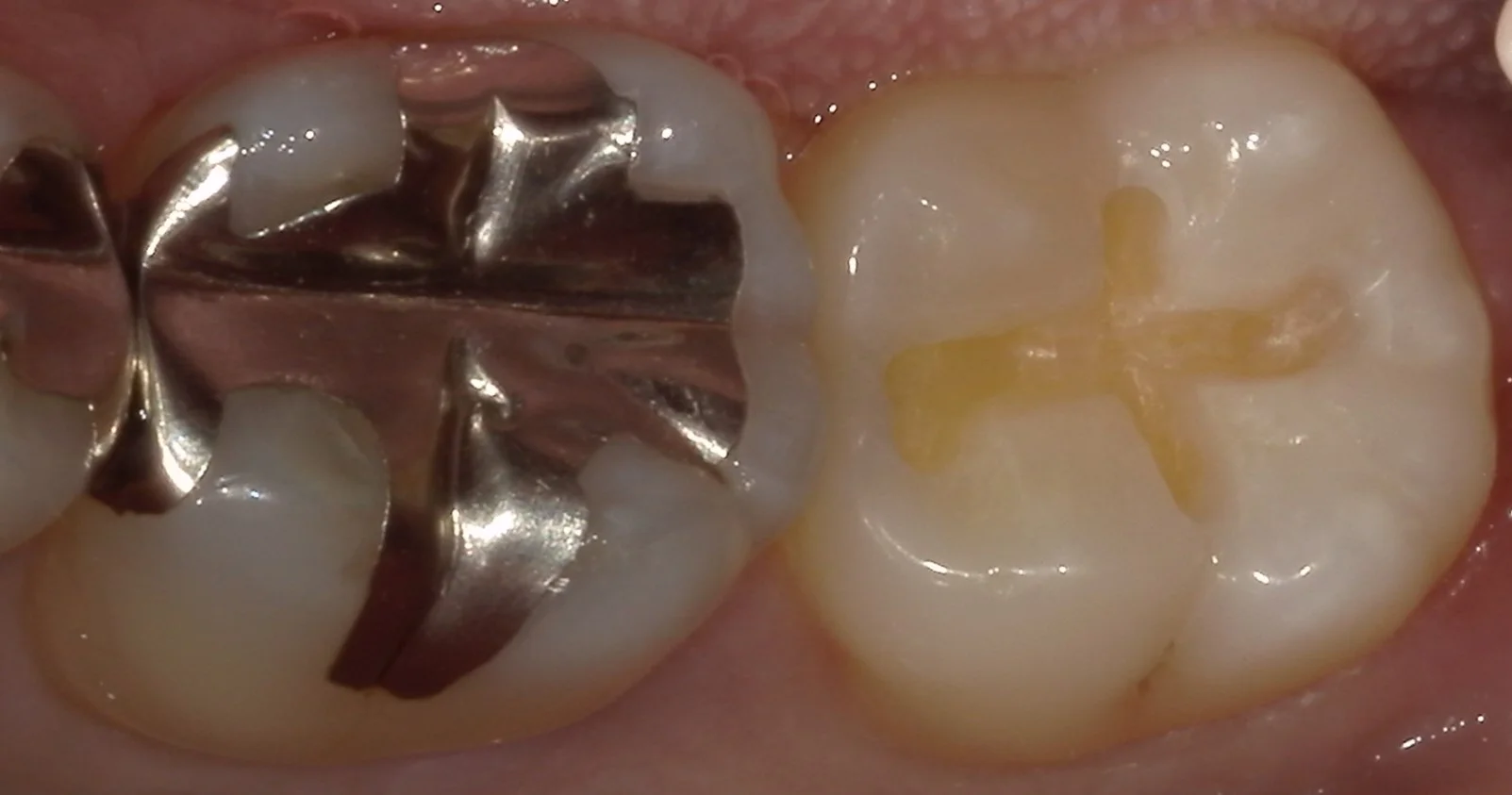 小さな虫歯ほど自費がおすすめ。｜坂寄歯科医院（取手市藤代） - 画像3