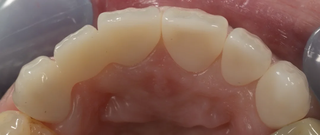 審美治療：セラミック｜坂寄歯科医院（取手市藤代） - 画像5