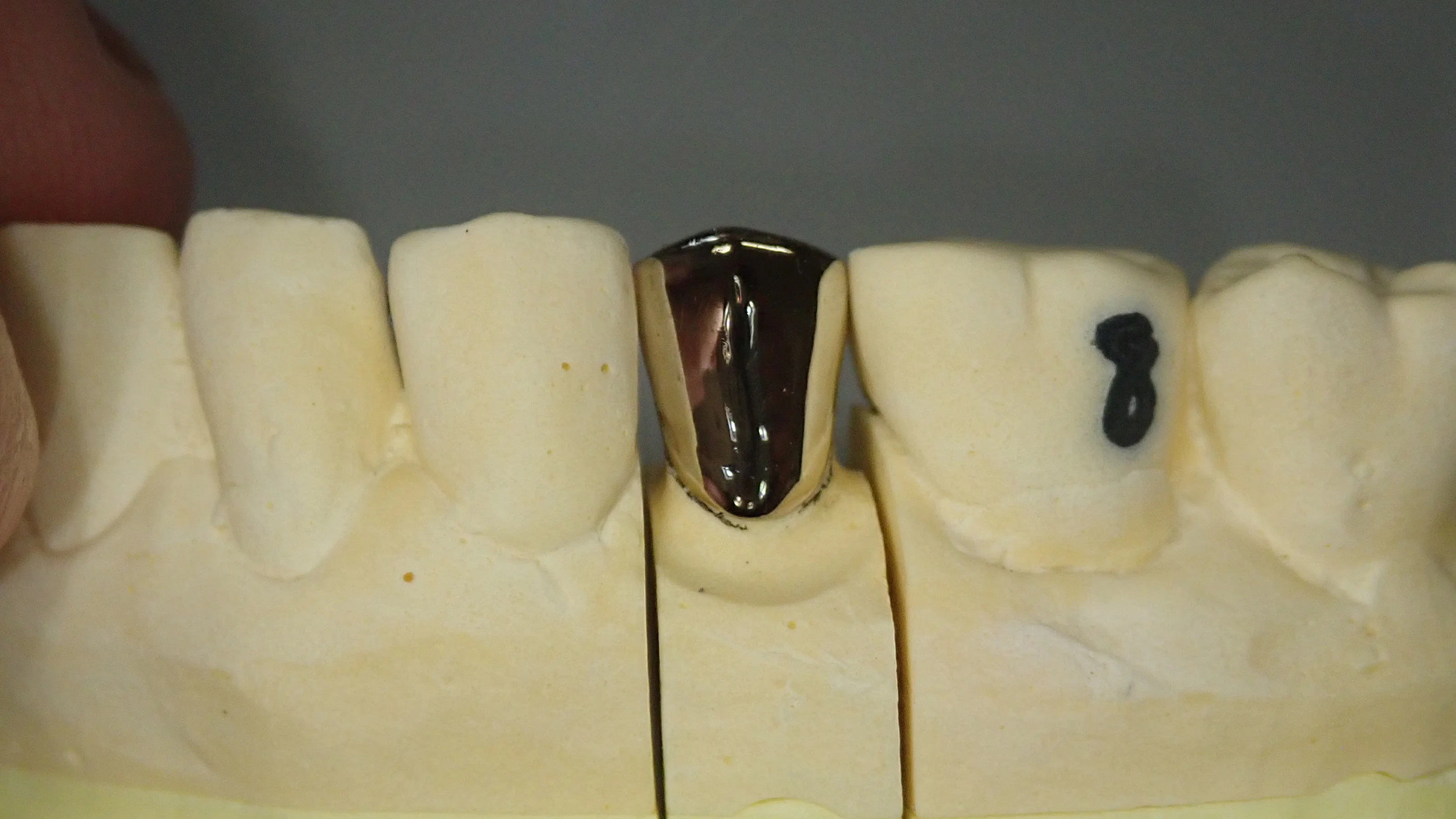 メタルクラウン｜坂寄歯科医院（取手市藤代） - 画像4