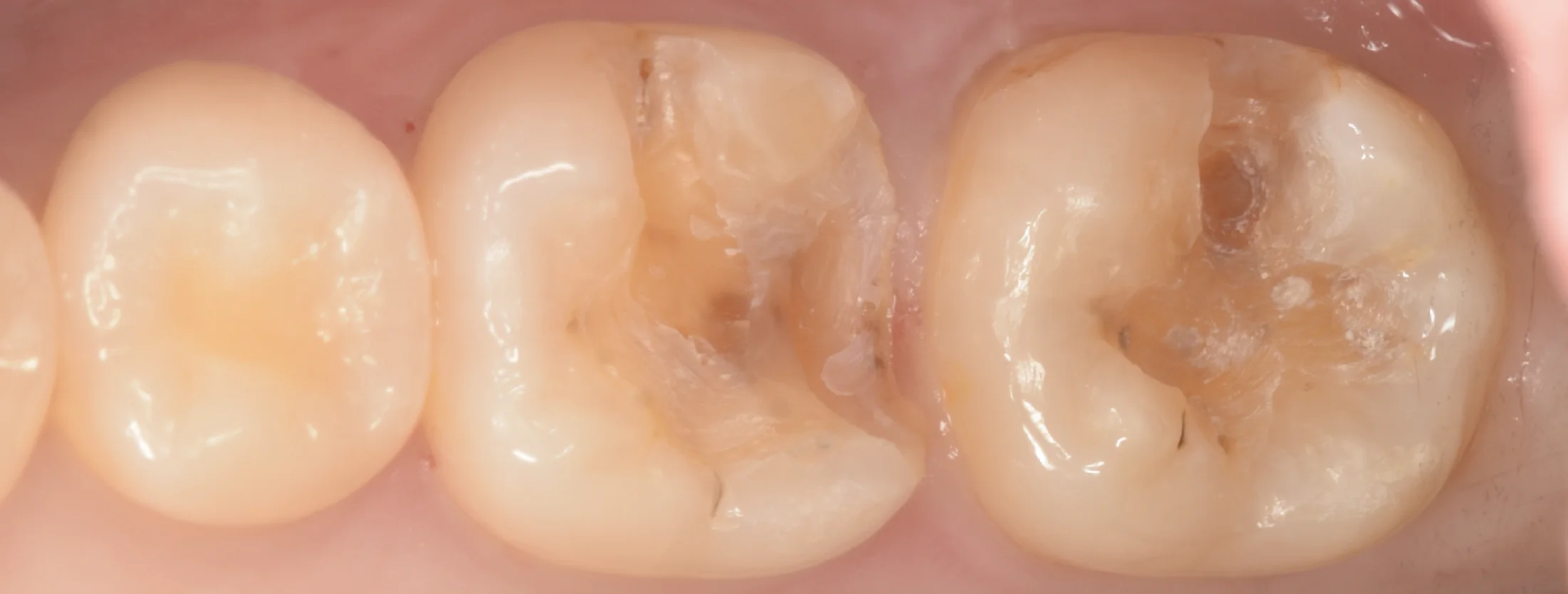 歯科医師の方のCAD/CAMインレーを治療。｜坂寄歯科医院（取手市藤代） - 画像2