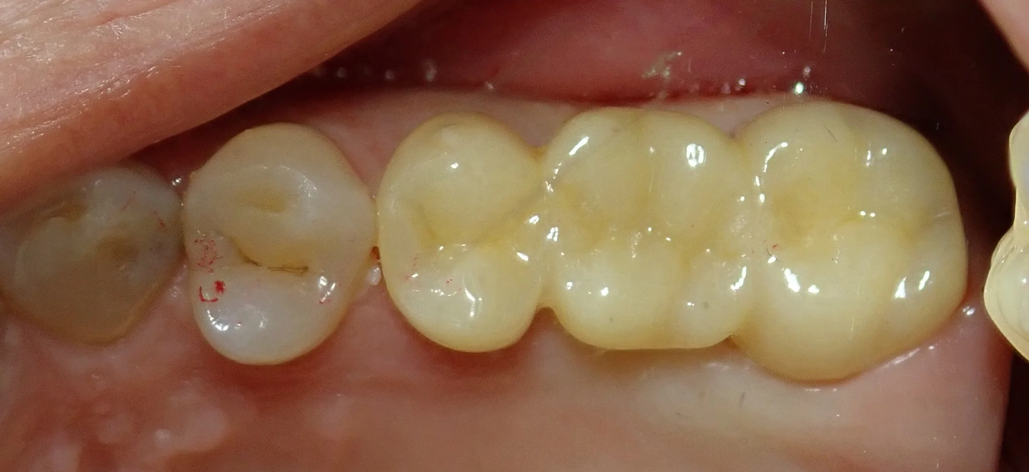 奥歯のセラミックブリッジ｜坂寄歯科医院（取手市藤代） - 画像4