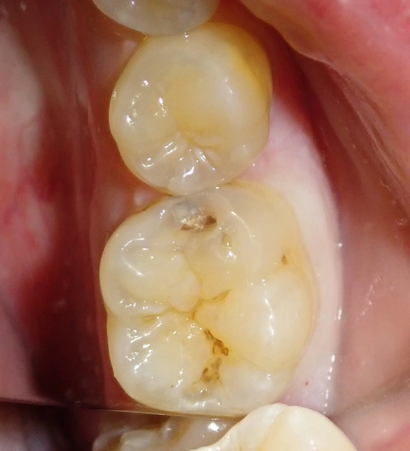 虫歯はない･･･?本当に･･･?｜坂寄歯科医院（取手市藤代） - 画像2