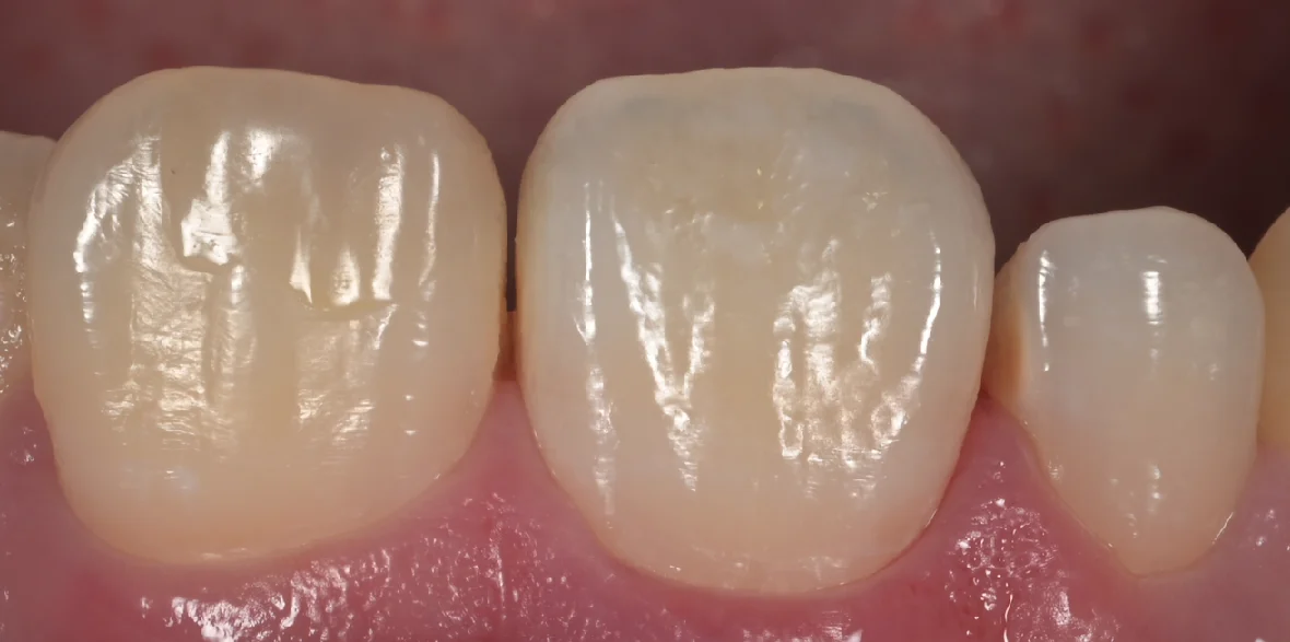 ICON治療にてホワイトスポットを改善。｜坂寄歯科医院（取手市藤代） - 画像5