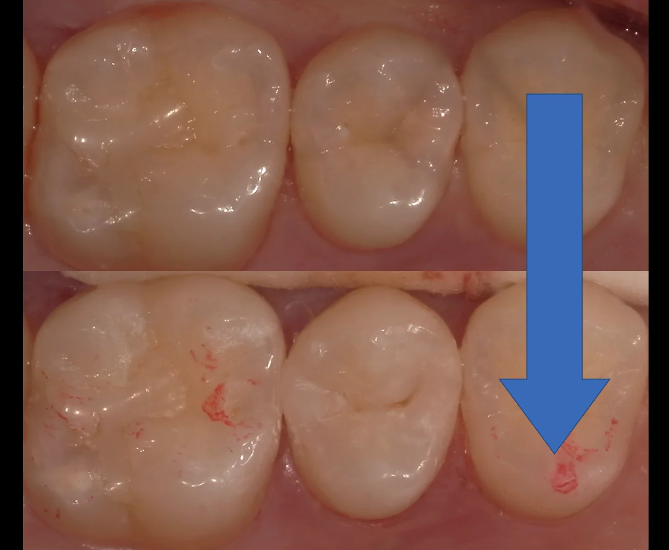ダイレクトボンディングの長期経過｜坂寄歯科医院（取手市藤代） - 画像3