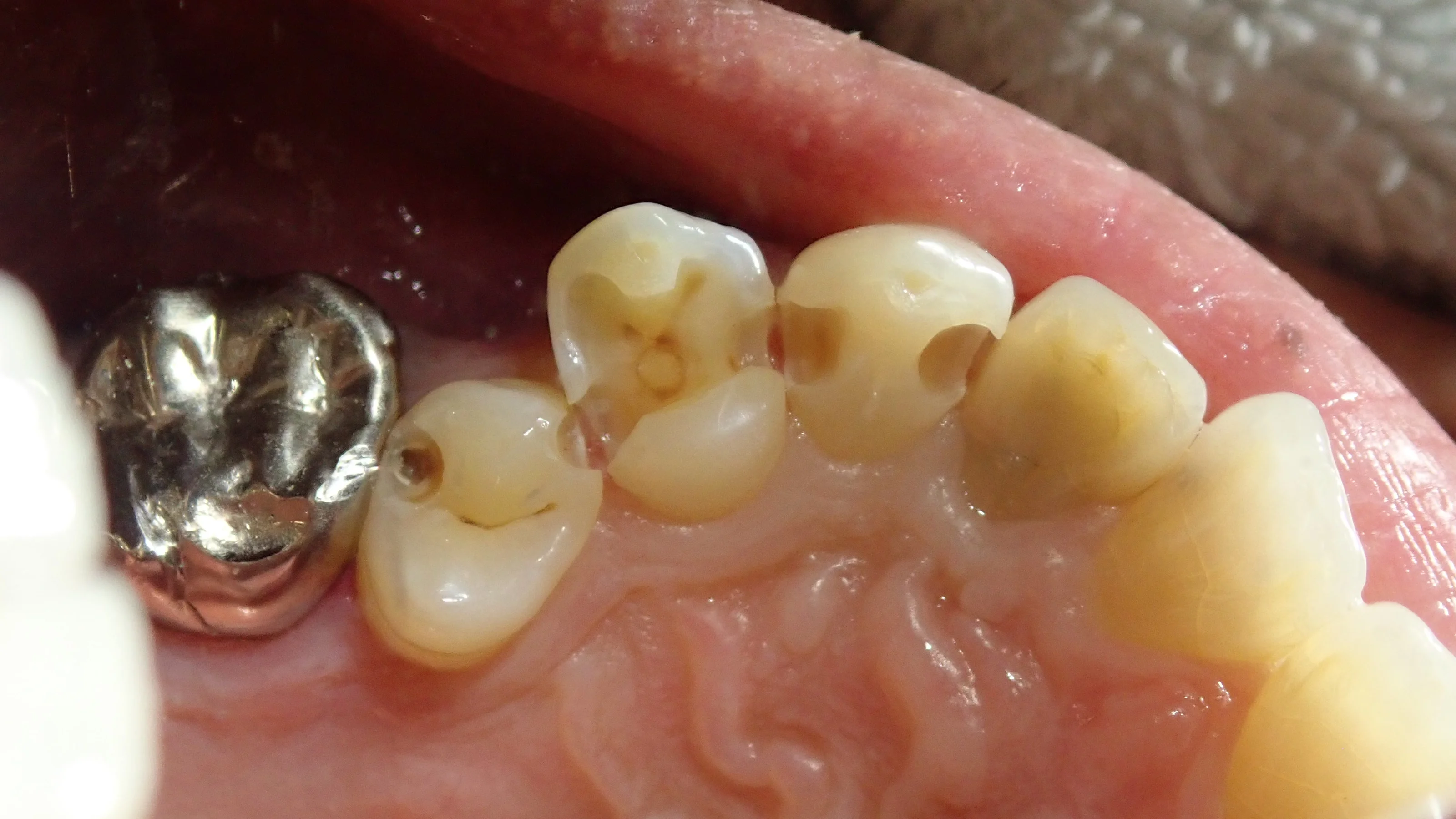 左上3本まとめてダイレクトボンディング|坂寄歯科医院(取手市藤代) - 画像3