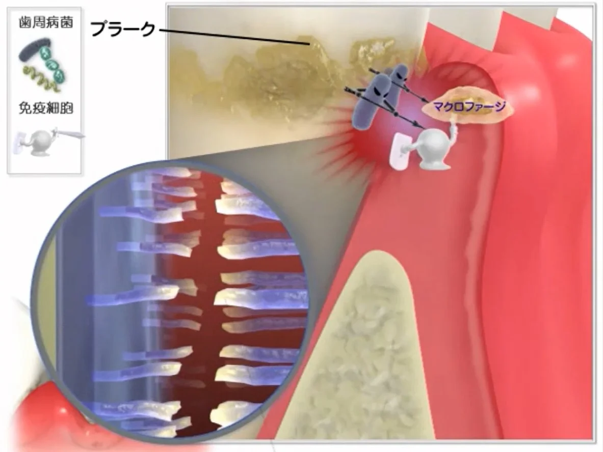 炎症が長引き歯肉の繊維が断裂しつつある断面図