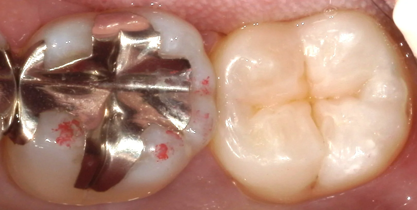 奥歯の自費の白い詰め物。術後数週間後もあります。｜坂寄歯科医院（取手市藤代） - 画像5