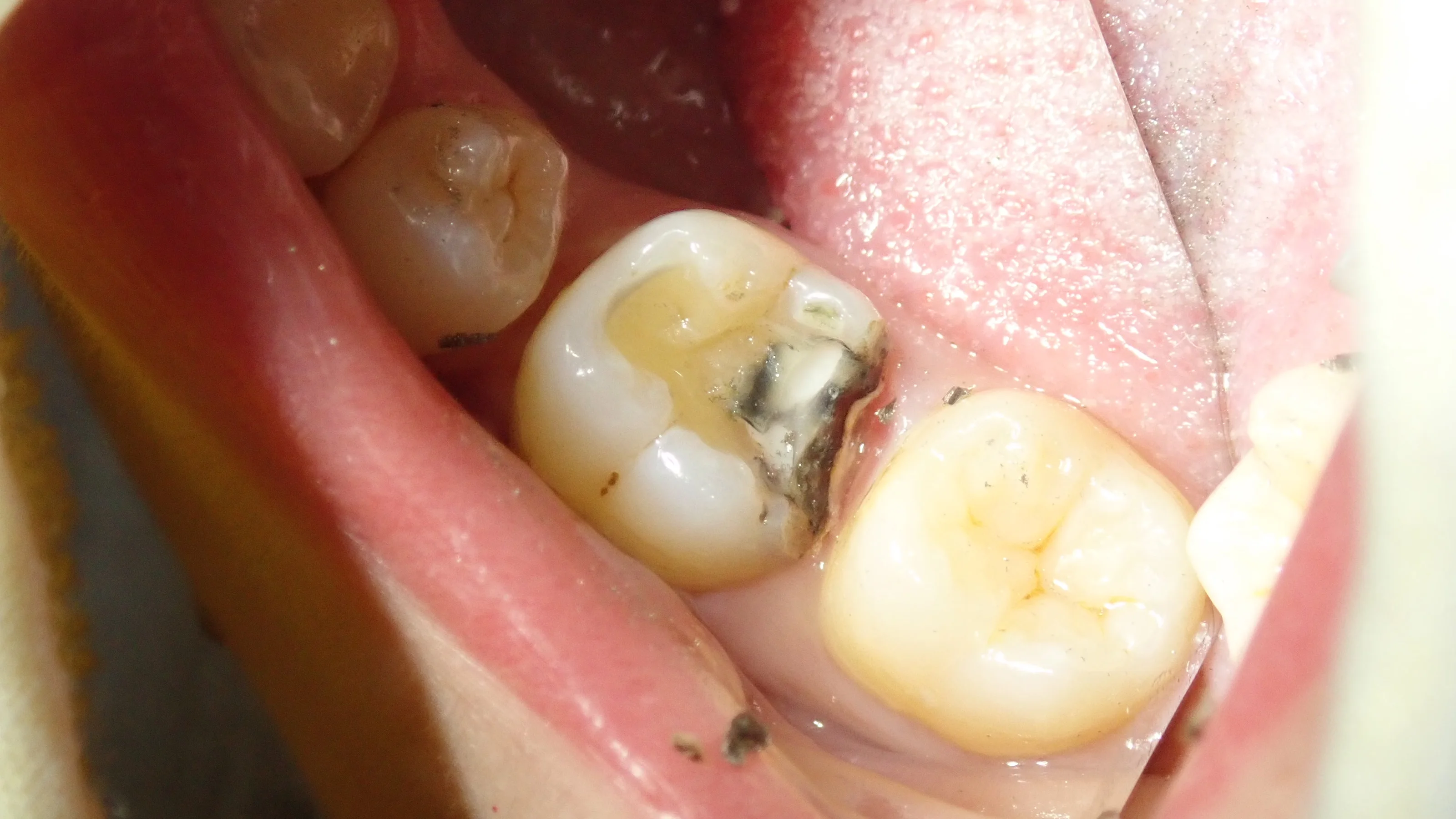 奥２本のダイレクトボンディング｜坂寄歯科医院（取手市藤代） - 画像5