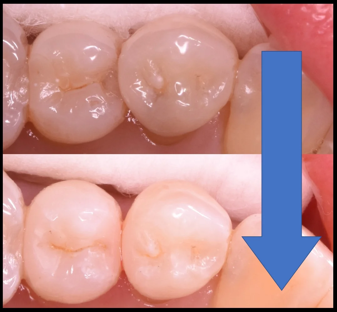 奥歯の歯並びが悪くなってしまっている所の治療｜坂寄歯科医院（取手市藤代） - 画像7