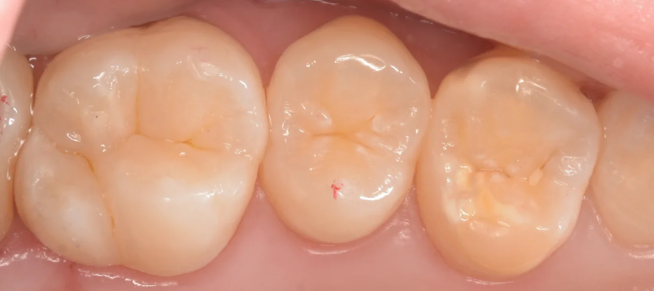 自費の白い詰め物。｜坂寄歯科医院（取手市藤代） - 画像4