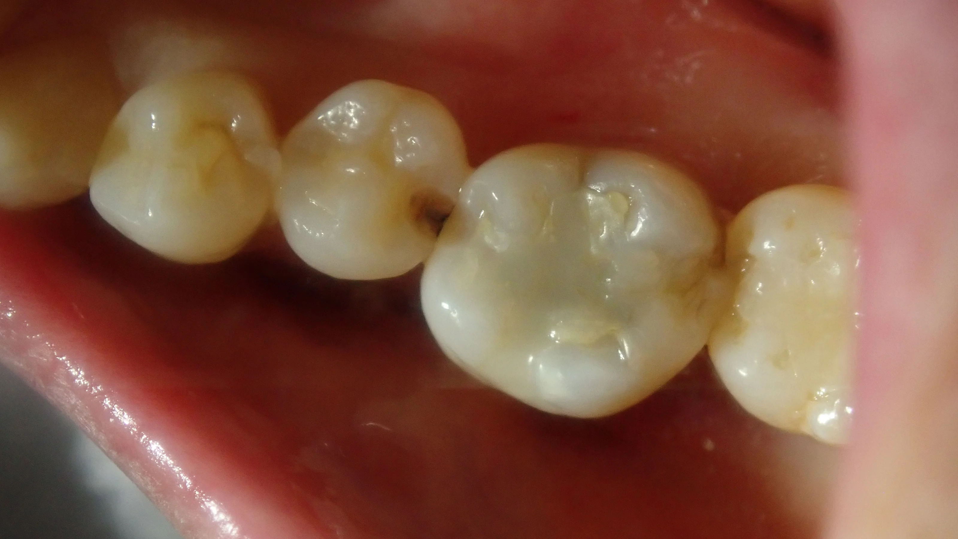 ダイレクトボンディング⑦｜坂寄歯科医院（取手市藤代） - 画像2