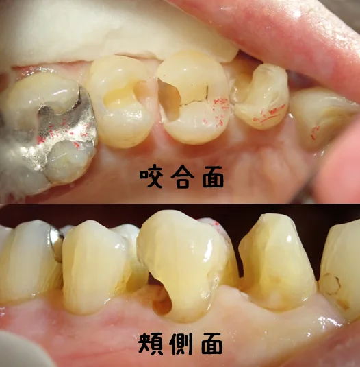 3本連続ダイレクトボンディング｜坂寄歯科医院（取手市藤代） - 画像3