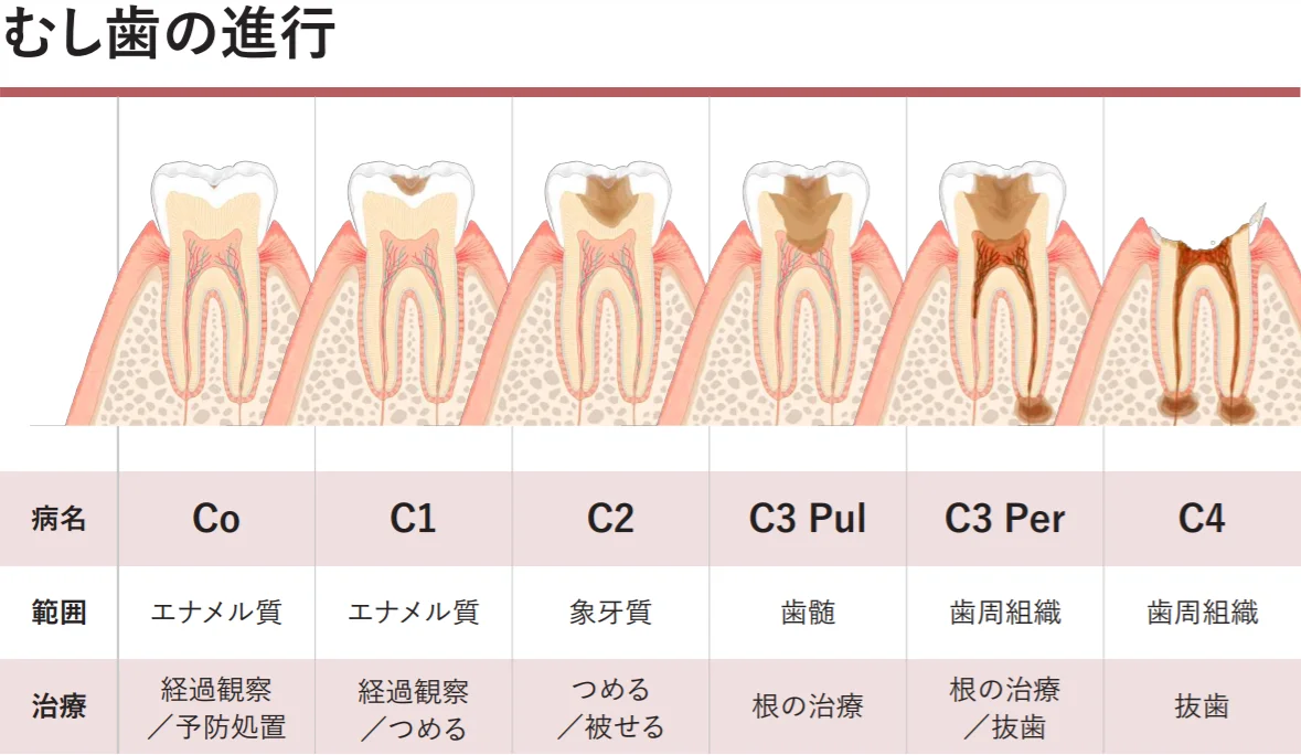 虫歯の進行と歯髄への刺激の変化