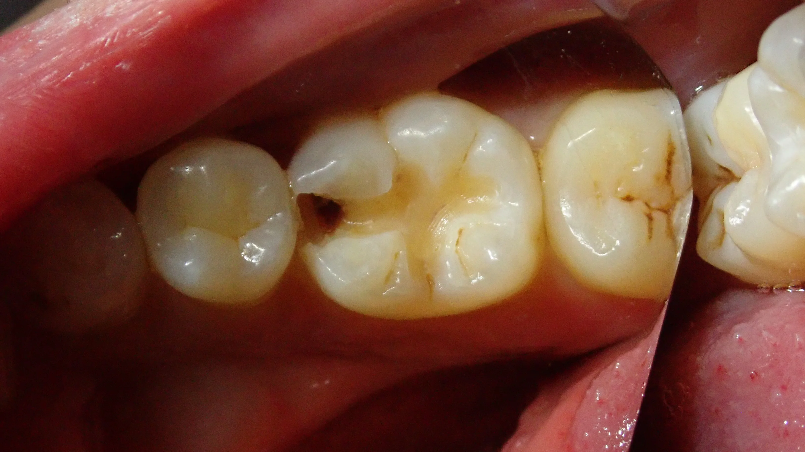 ダイレクトボンディング⑧｜坂寄歯科医院（取手市藤代） - 画像3