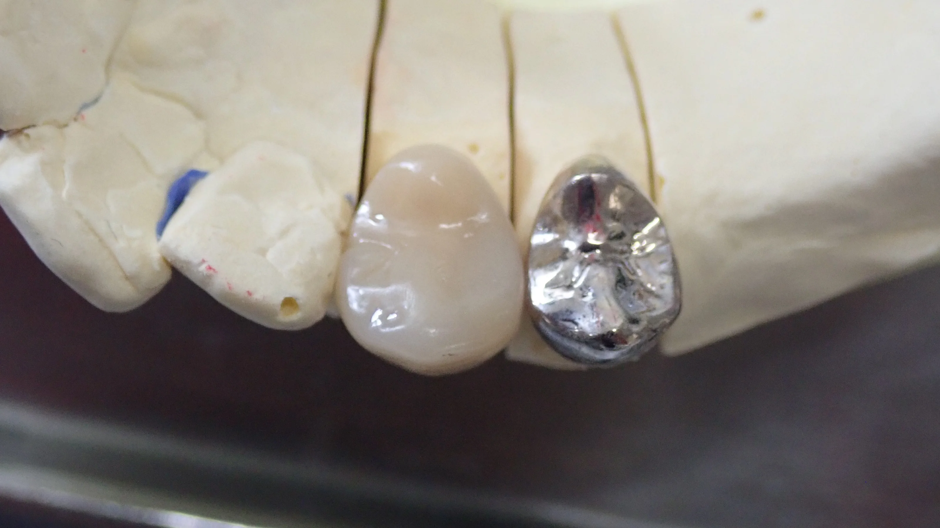 硬質レジンジャケット冠｜坂寄歯科医院（取手市藤代） - 画像3