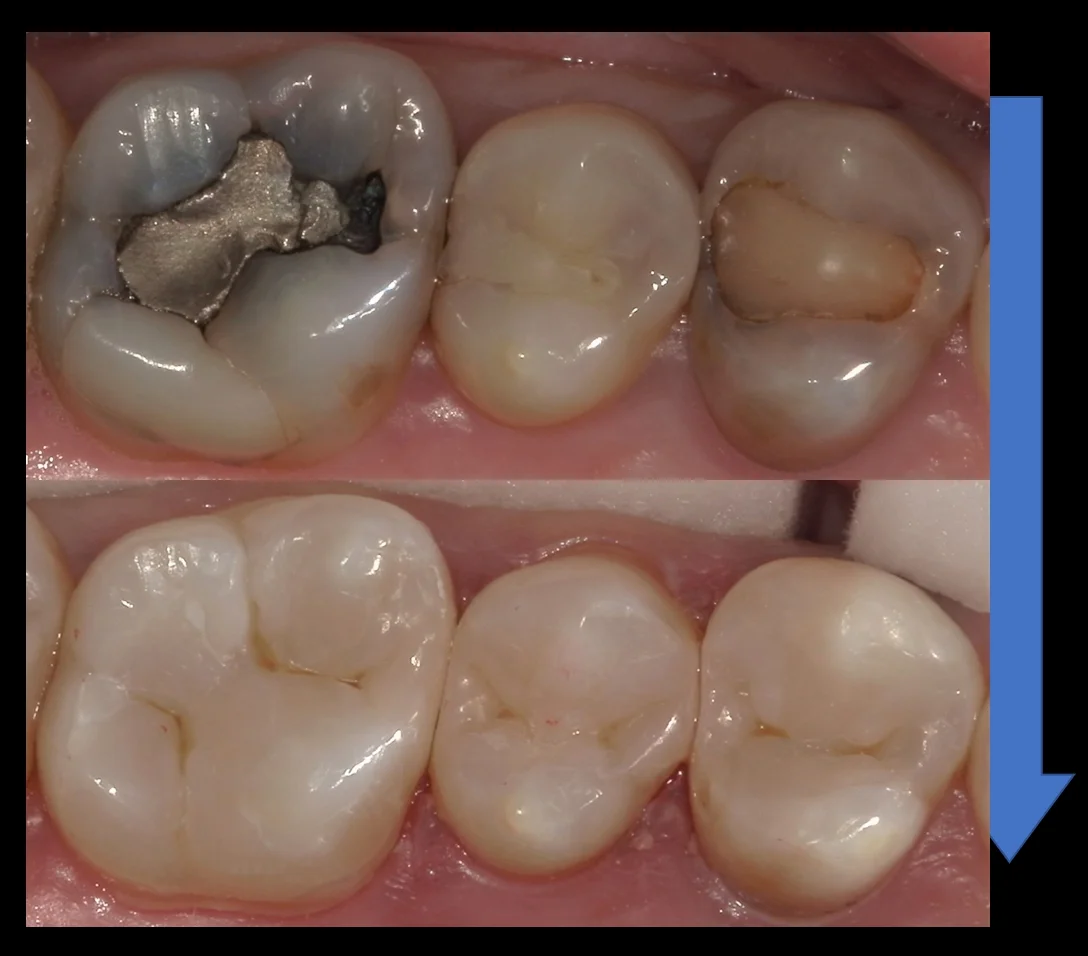 遠方から来院の方を白い詰め物にて治療。｜坂寄歯科医院（取手市藤代） - 画像8