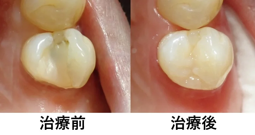 ダイレクトボンディング④｜坂寄歯科医院（取手市藤代） - 画像9