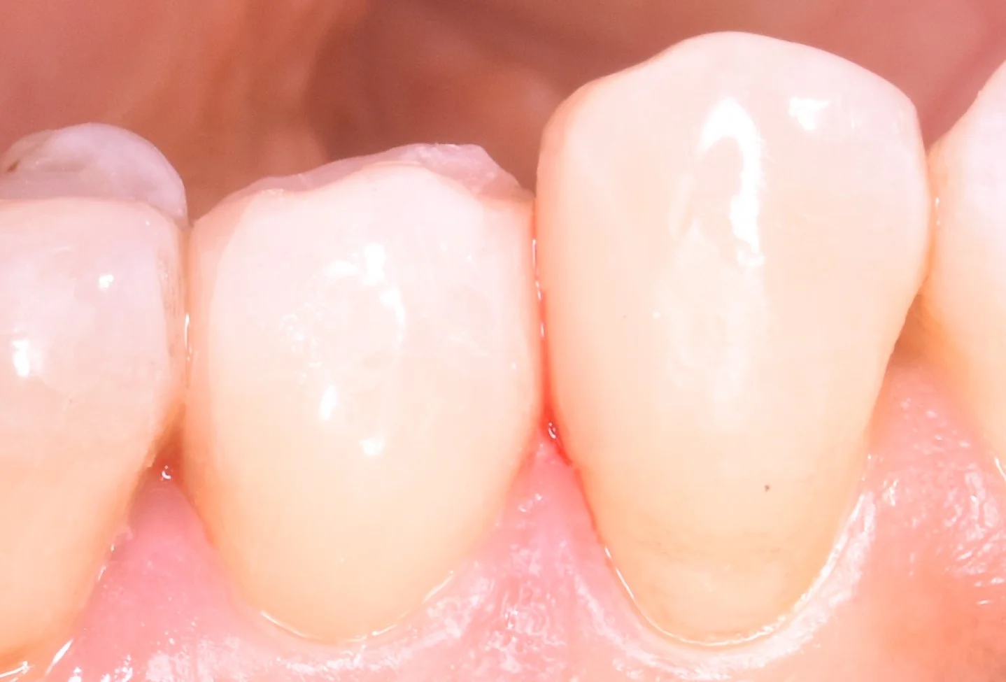 奥歯の歯並びが悪くなってしまっている所の治療｜坂寄歯科医院（取手市藤代） - 画像6