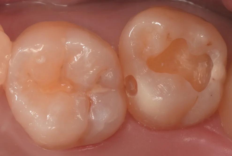 新しくできた虫歯と古い詰め物を同時に治療。｜坂寄歯科医院（取手市藤代） - 画像3