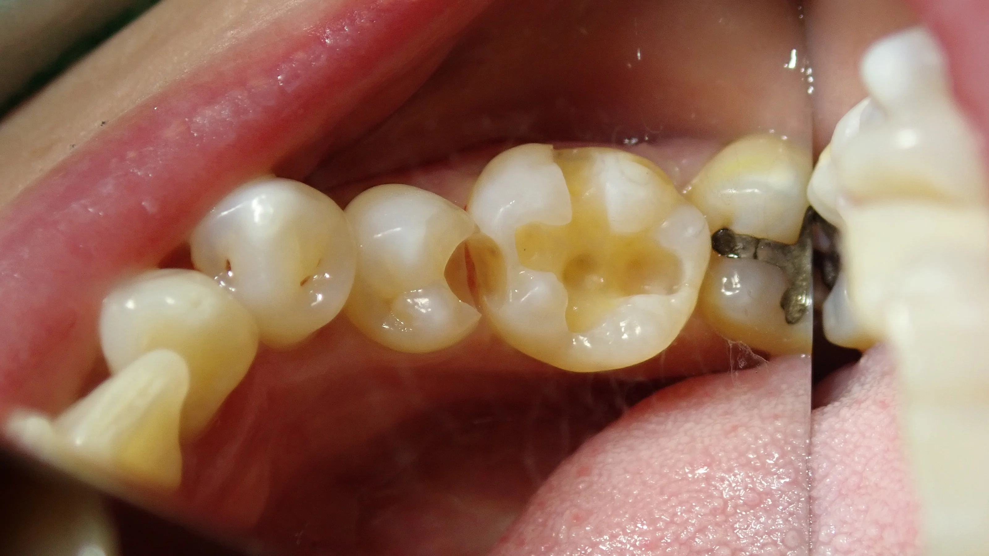 下の奥歯2本の詰め物｜坂寄歯科医院（取手市藤代） - 画像3