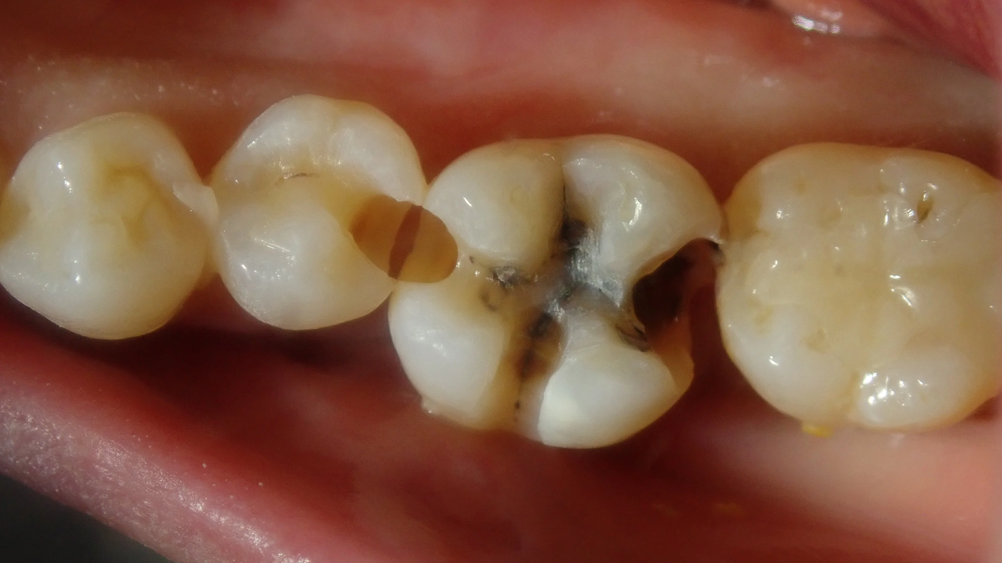 ダイレクトボンディング⑦｜坂寄歯科医院（取手市藤代） - 画像3